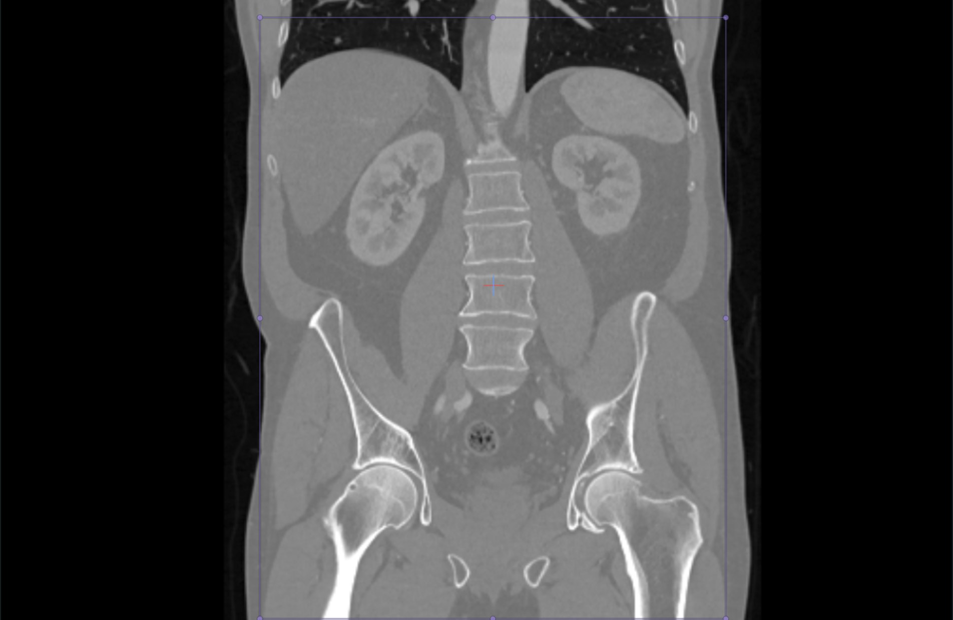 De-identified CT, coronal view of the lumbar spine, pelvis and hips